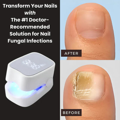 zoila™ - Nail Fungus Laser Device